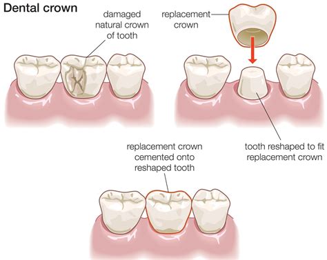 Dental Crowns in Sydney CBD | Sydney CBD Dentistry