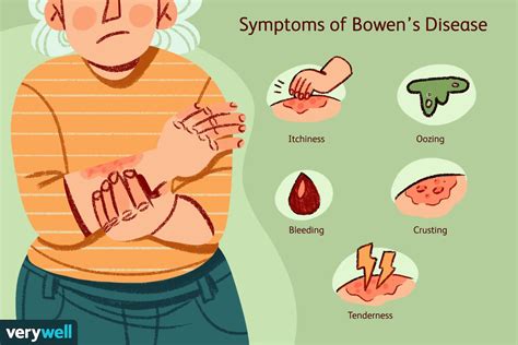 Bowen's Disease: Causes, Treatment, Prognosis and More