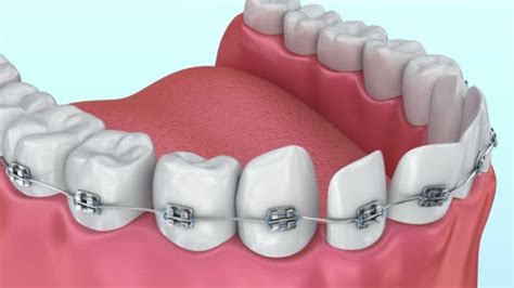 Teeth Braces Alignment Process Medically Accurate Animation — Stock ...