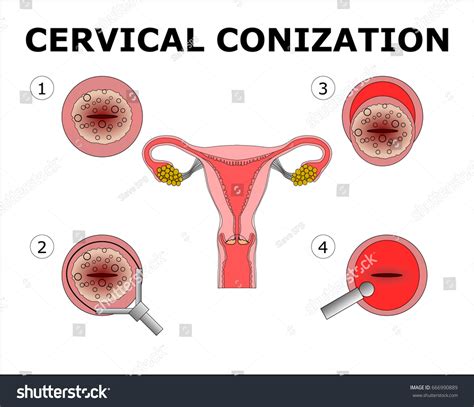 Cervical Conization Vector Color Illustration Stock Vector (Royalty Free) 666990889 | Shutterstock