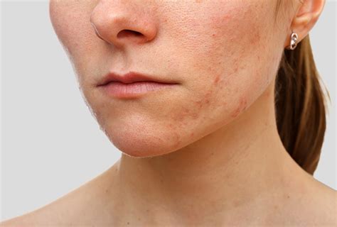 Home Remedies for Eczema Scars | Top 10 Home Remedies