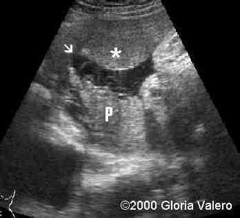 📃 Succenturiate & bilobate placenta