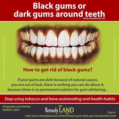 Black gums or dark gums around teeth : Gum discoloration - Remedy Land