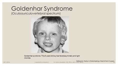 goldenhar syndrome : CHL, Facial asymmetry, microtia,atresia, abnormal heart