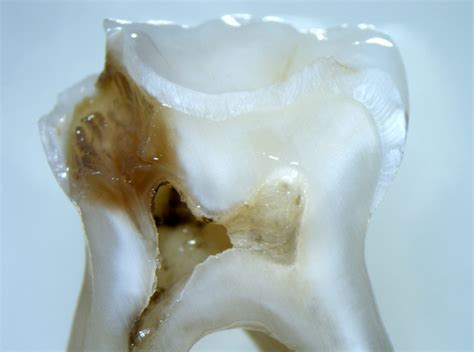 The 5 Stages of Tooth Decay | News | Dentagama