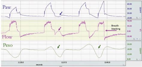 Reverse triggering and breath stacking in volume assist-control. The... | Download Scientific ...