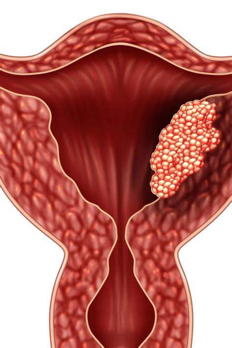 Endometrial cancer: Symptoms, staging, treatment, and causes