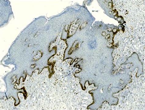 Pathology Outlines - Melanotic macule