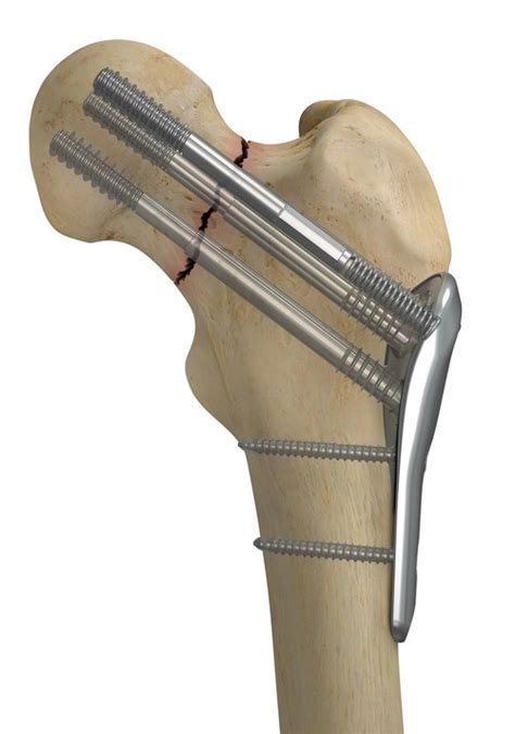 Smith & Nephew Launches the CONQUEST FN™ Femoral Neck Fracture System, a Fresh Approach to Hip ...