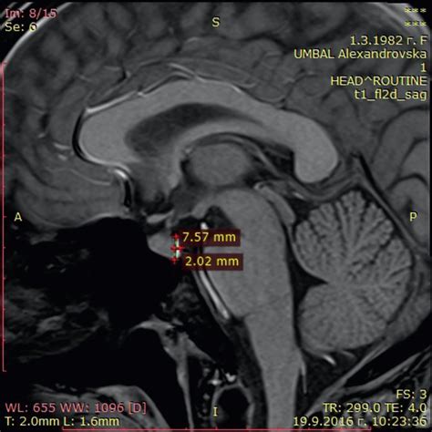 Measuring the neurohypophysis. Length (anteroposterior diameter) -2.02 ...