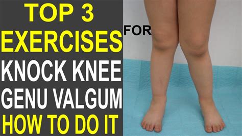 TOP 3 EXERCISES FOR KNOCK KNEE | GENU VALGUM EXERCISES | - YouTube