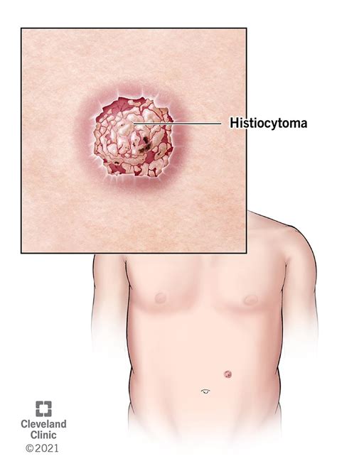 Histiocytoma in Humans: Types, Causes, Symptoms, Treatment & Prognosis