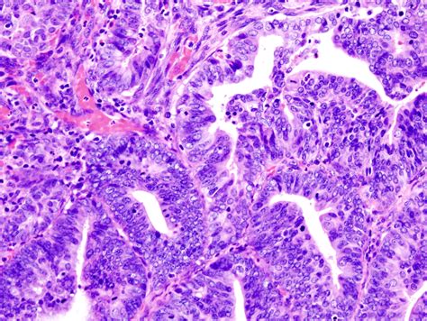 File:Endometrial adenocarcinoma (2).jpg