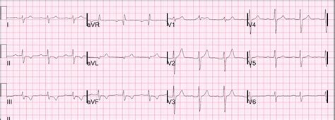 Dr. Smith's ECG Blog: New RBBB and subtle NSTEMI