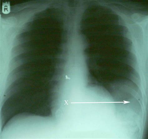 Ruptured Spleen X Ray