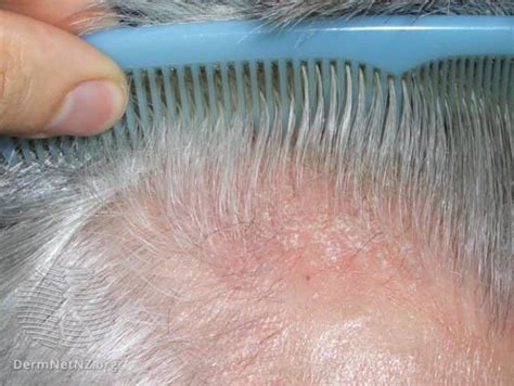 Dry Scalp: Causes and Treatments