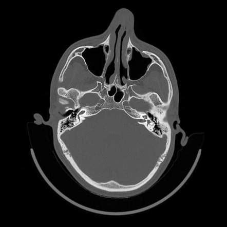 Inner ear malformations (classification) | Radiology Reference Article | Radiopaedia.org