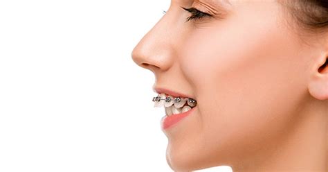 Correcting Overbites with Braces: 4 Key Methods Explained