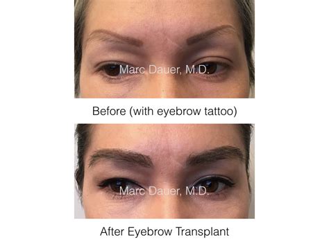 Eyebrow Restoration Los Angeles, Eyebrow Transplant Procedure