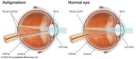 Astigmatism | Definition & Treatment | Britannica