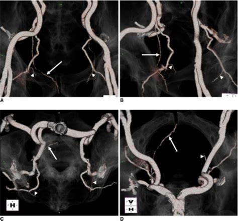 Figure 3:The Incidence and Anatomy of Accessory Pudendal Arteries as ...