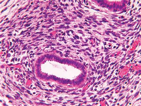 ( a ) A distinct focus of tumor was present in a sarcoma botryoides of ...