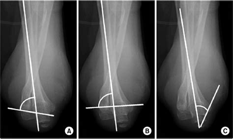 Measurement in forearm pronation-elbow flexion view. (A) Baumann angle.... | Download Scientific ...