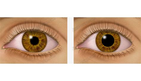 Pupil dilation illustrated depicting large and small pupil