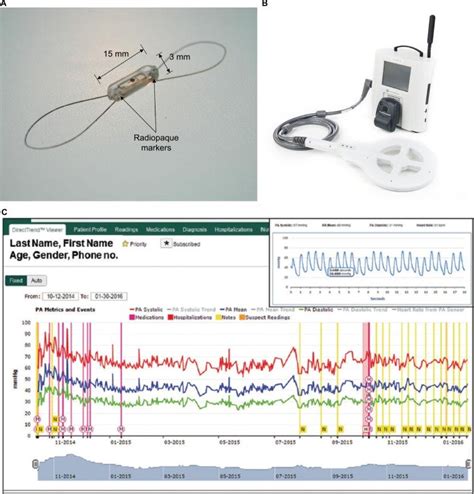 CardioMems device. Notes: The CardioMems system consists of three ...