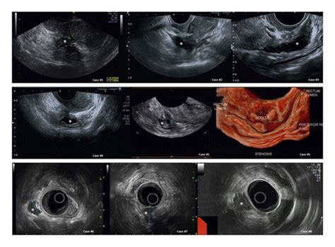 Images of bowel endometriosis (sonographic details of each case are ...