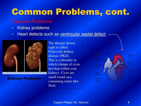 PPT - Patau Syndrome PowerPoint Presentation, free download - ID:6905046