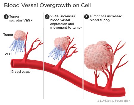 Angiogenesis Inhibitors | LUNGevity Foundation