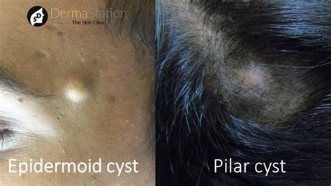 Epidermoid and Pilar Cysts