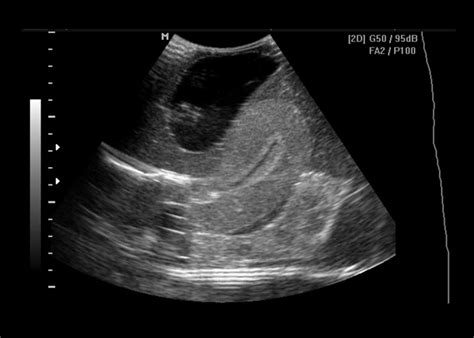 Ultrasound Of Pelvis