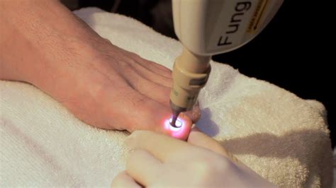 Q Clear Laser Nail Fungus Treatment Reviews - Nail Ftempo