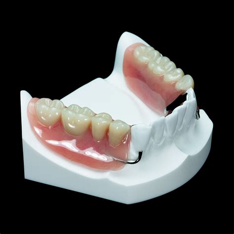 IM-20 Partial Mandible with 2 Locators | Paradigm Dental Models