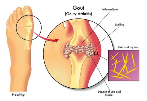 Stem cells treatment of gout in Ukraine | Mediland - leading stem cell ...