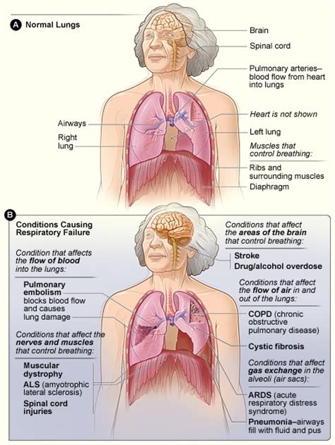 Acute respiratory insufficiency/ failure - Practical skills in pediatrics: common pediatric ...