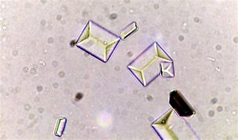 Types of Crystals Found In Human Urine and Their Clinical Significance | Faculty of Medicine