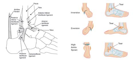 Ankle Pain On Outside Of Foot Factory Sale | emergencydentistry.com