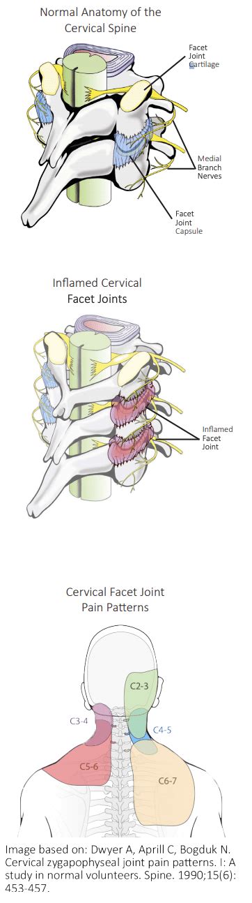 Cervical Facet Joint Injection - Highland, IN: Kanuru Interventional ...