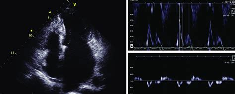 Echocardiogram in patient 3 at the time of admission to neurology... | Download Scientific Diagram