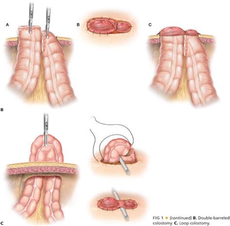 Diverting Loop Colostomy Cpt Code – cptcode.se