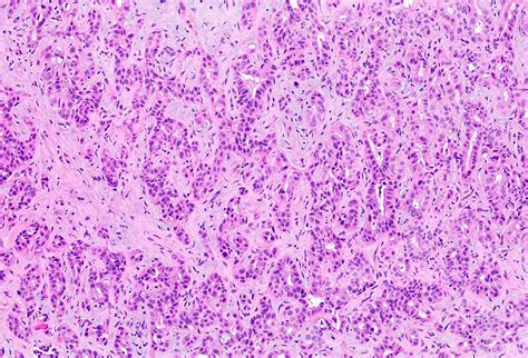 Cholangiocarcinoma Histology