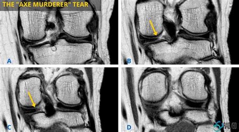 Meniscus Posterior Horn Part 1: An axe murderer meets the ghost meniscus - Radedasia