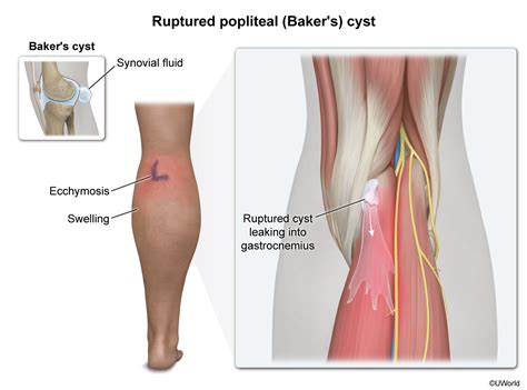 Ruptured Popliteal (Baker's) Cyst — Cote Illustration