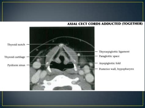 Larynx anatomy ct and mri