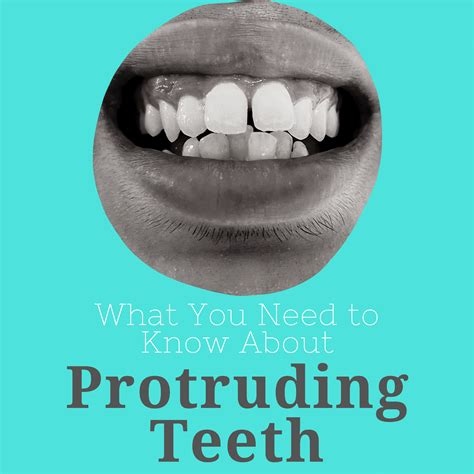 What You Need to Know About Protruding Teeth