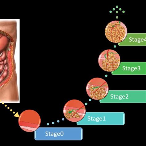 The different stages of colon cancer. | Download Scientific Diagram