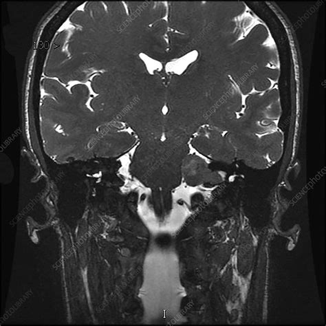 Vestibular Schwannoma, MRI - Stock Image - C039/4312 - Science Photo Library